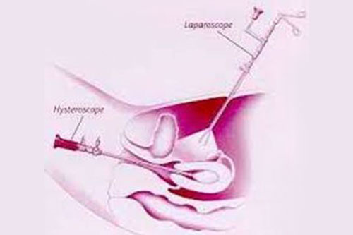 Laparoscopy-and-Hysteroscopy